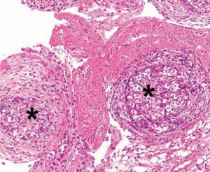 Lymph node metastases in SC+ORT mice