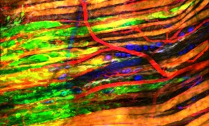 3D multi-channel imaging and movies of cancer cells in living mice show how streams of melanoma cells (green) invade skin tissue. The cells are guided by structures such as muscle fibres (orange), nerve fibres (blue), collagen (grey) and blood vessels (red).