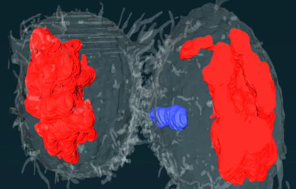 A 3D model of two cells imaged using FIB-SEM, with chromatin and a lagging chromosome highlighted. 